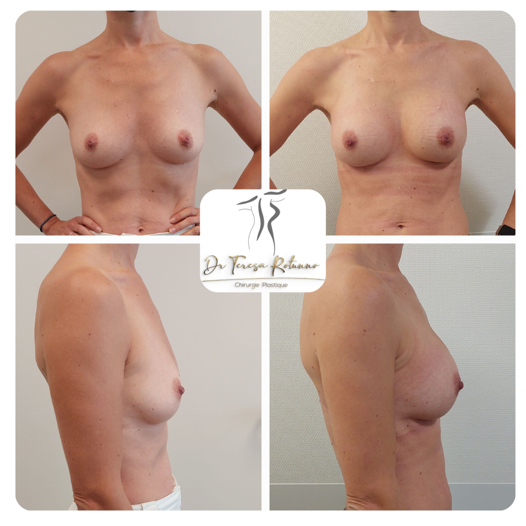 Belle augmentation mammaire Genève