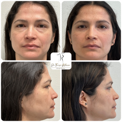 blépharoplastie Genève