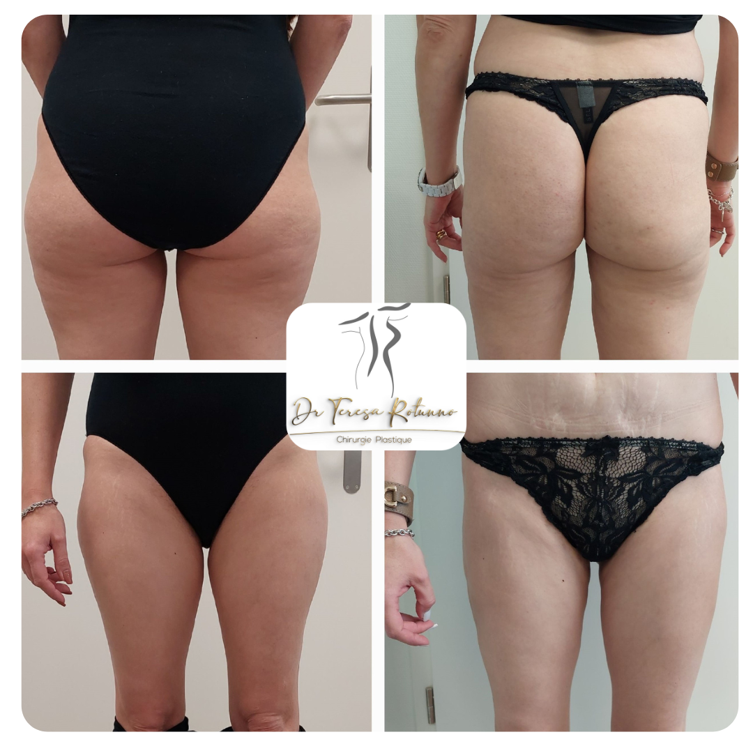 liposuccion des flancs et des cuisses, 3 mois post-opératoire 
