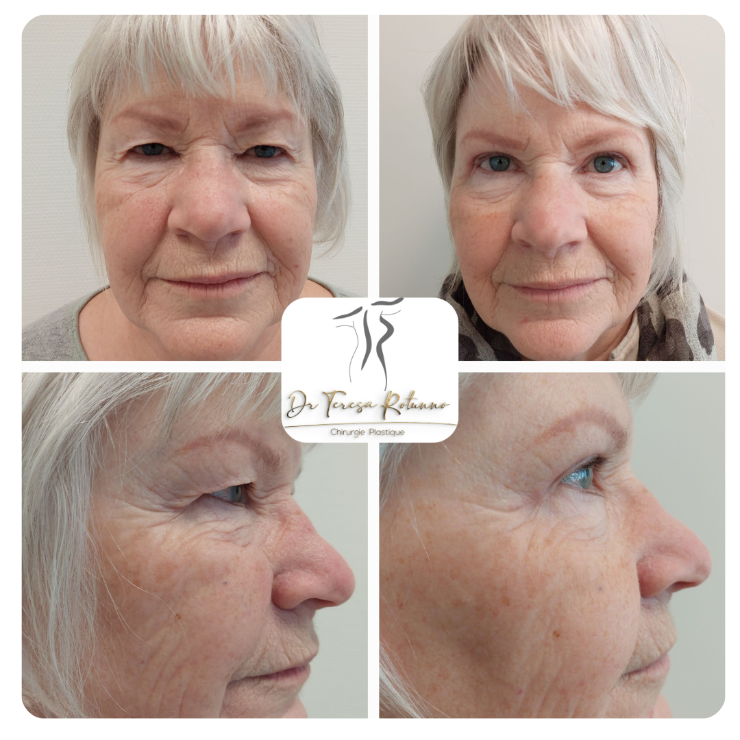 blépharoplastie Genève
