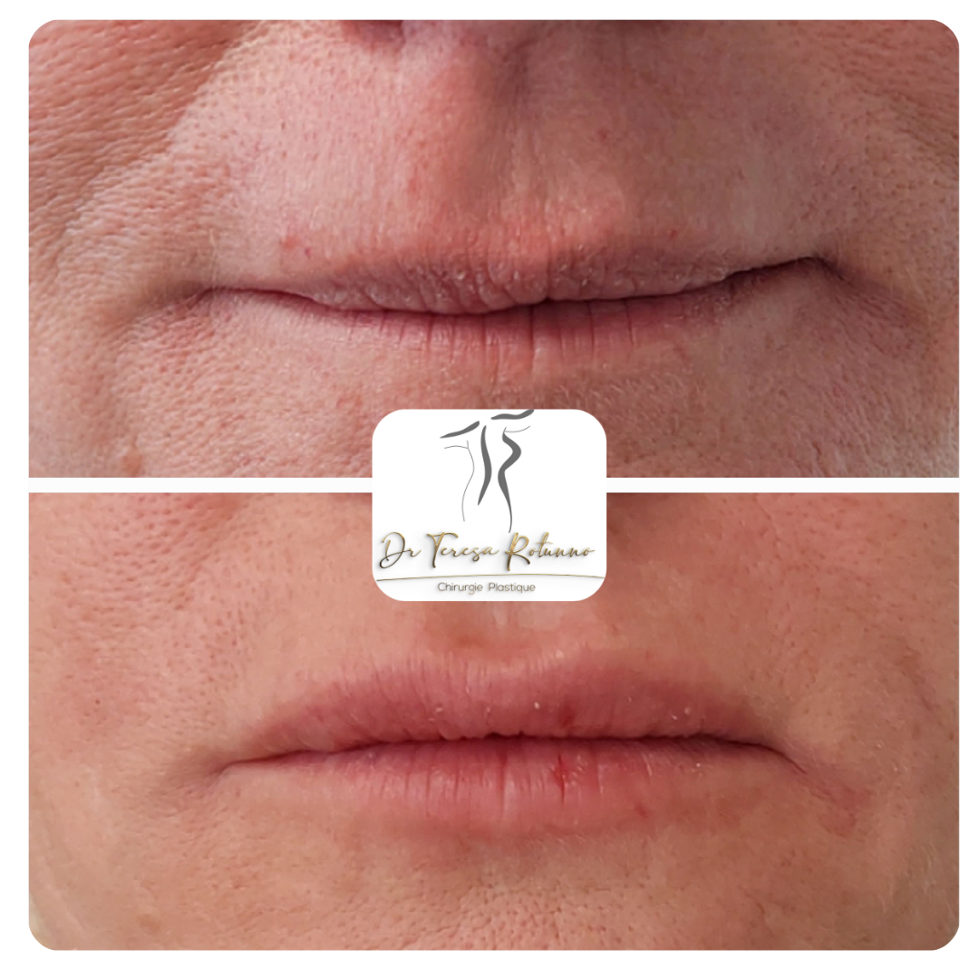hydratation des lèvres par injection d'acide hyaluronique 