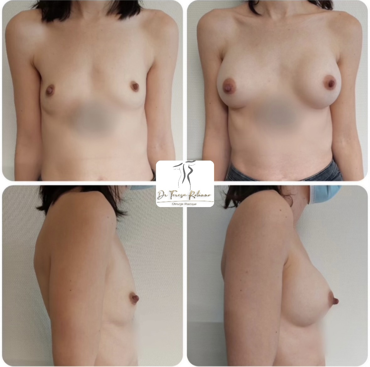 Augmentation mammaire Genève Suisse