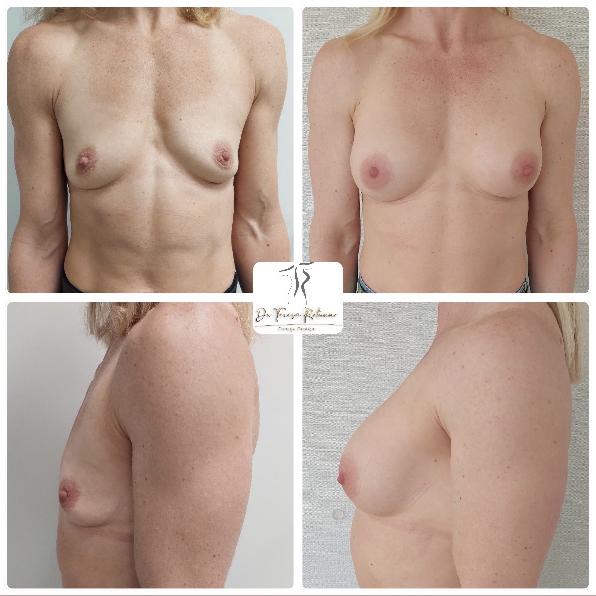 Augmentation mammaire Genève